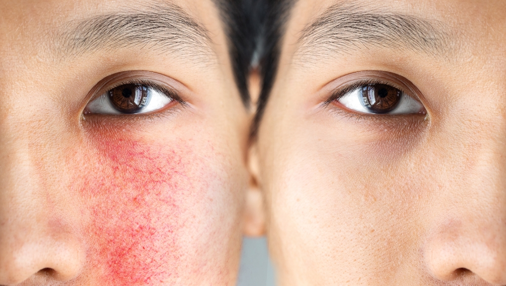 Rosacea – From New Classification to Latest Treatments: All You Need to Know