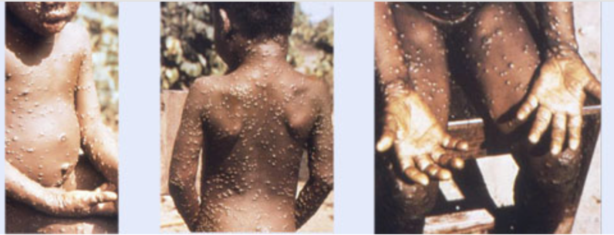 WHO Announced the End of Mpox as Global Health Emergency