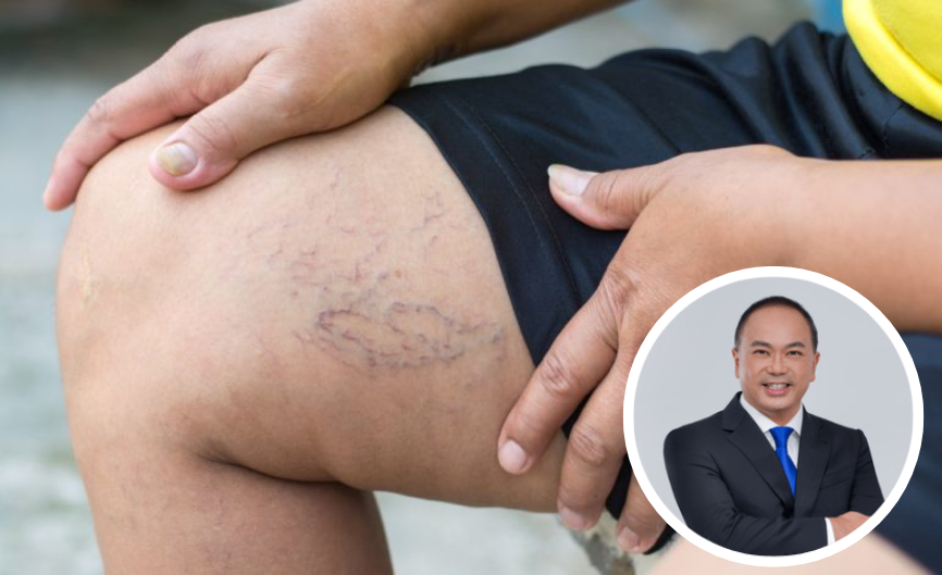 Varicose Veins: More Than Just A Cosmetic Issue?