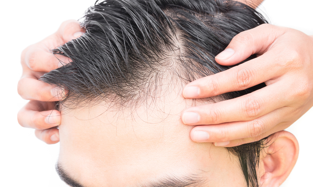 Oral Minoxidil: A Game-Changer for Hair Loss Treatment