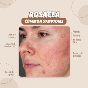 Common Symptoms of Rosacea