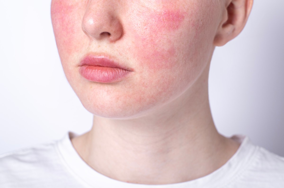 Is Your Face Just Red or Is It Rosacea? How to Tell Them Apart 