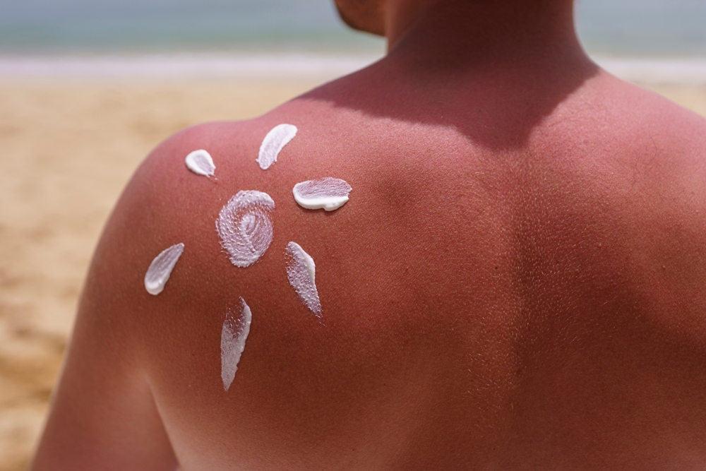 Soothe Sunburn: 5 Effective Remedies for Pain, Peeling, Blisters, and Swelling