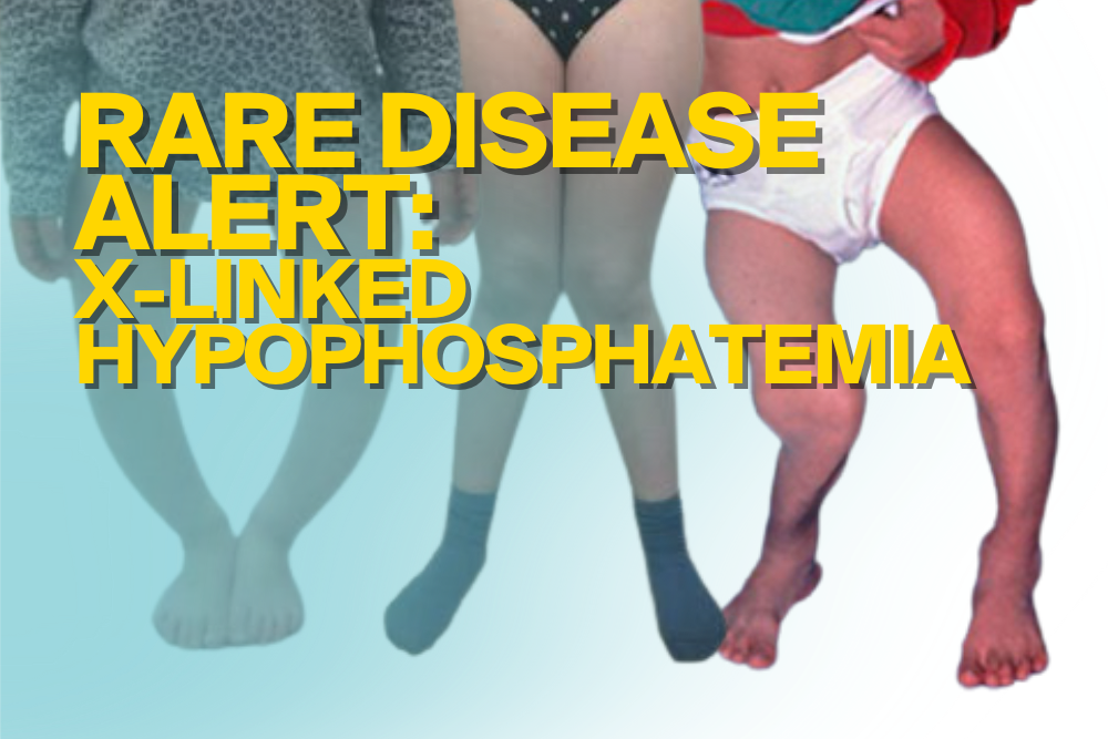 Crooked knees? It could be X-Linked Hypophosphatemia (XLH)