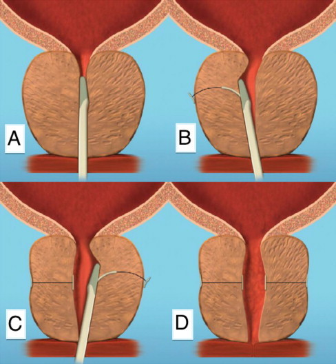 Image: Pictorial depiction of a Prostatic Urethral Lift (PUL) procedure. Source: Garcia C, Chin P, Rashid P, Woo HH. Prostatic urethral lift: A minimally invasive treatment for benign prostatic hyperplasia. Prostate Int. 2015;3(1):1-5. doi:10.1016/j.prnil.2015.02.002 