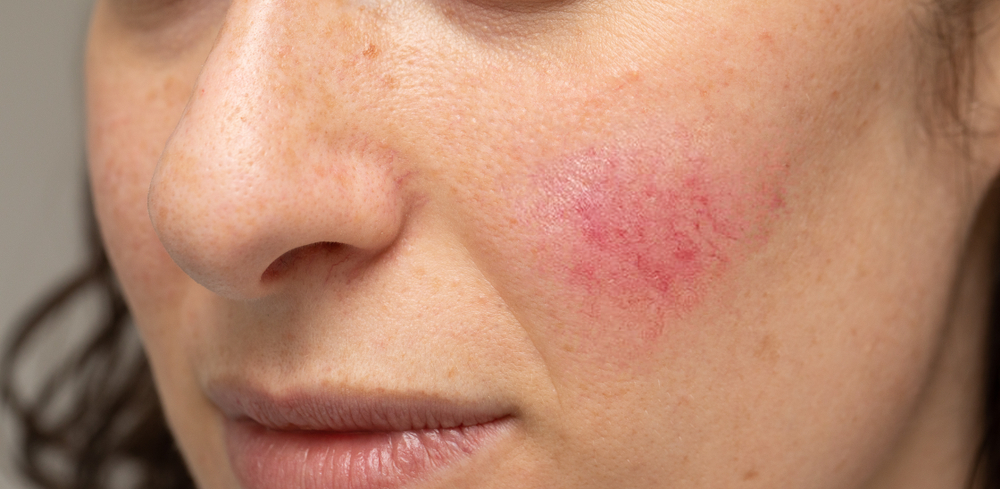 Managing Rosacea in Asia: Causes, Treatments, and Lifestyle