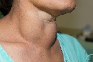 gouter enlarged thyroid gland