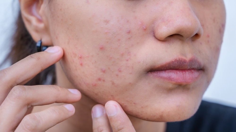 Acne Mapping: Understanding Breakouts on Different Facial Areas