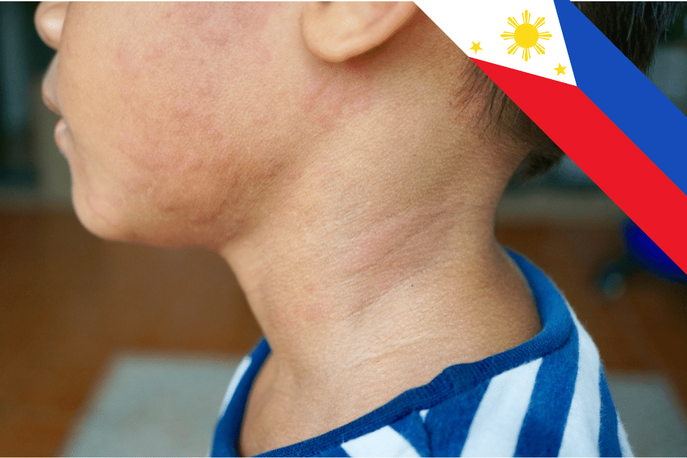 Philippine Department of Health Vaccinates Over 646,000 Children Against Measles