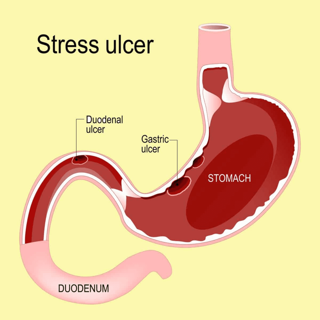 stress ulcers