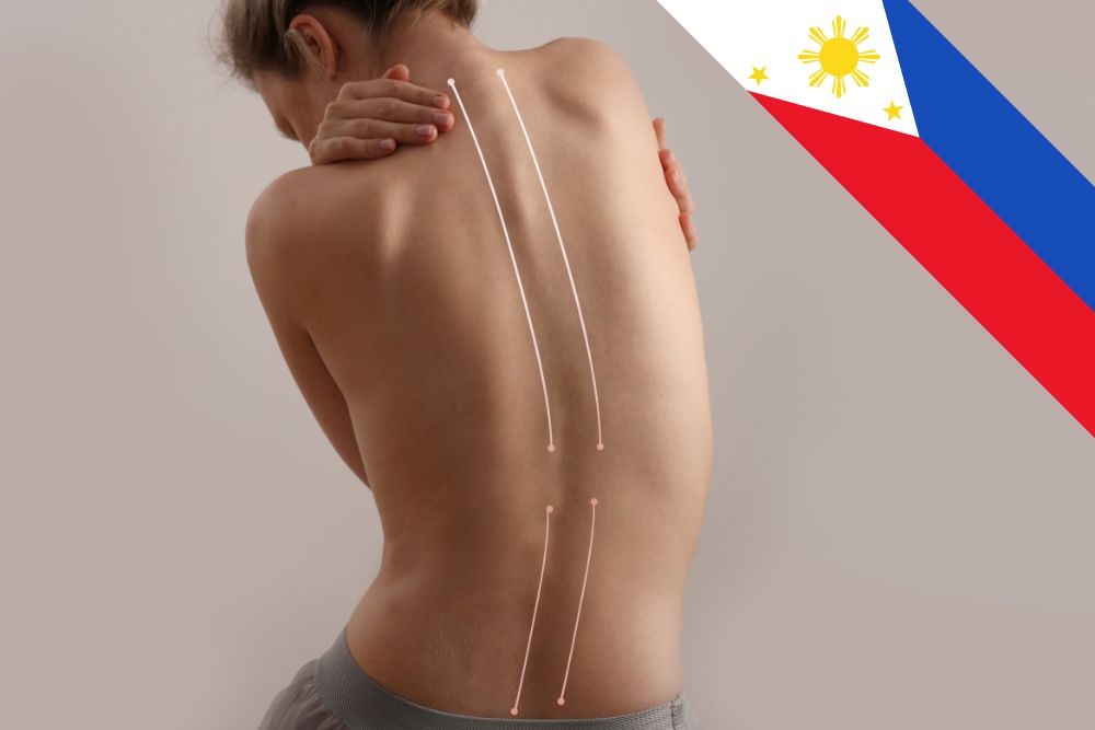 3 Million Filipinos Living with Scoliosis