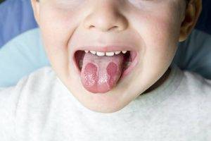 Geographic Tongue