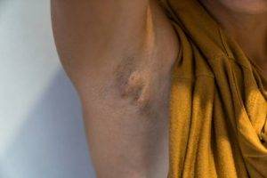 Hidradenitis Suppurativa