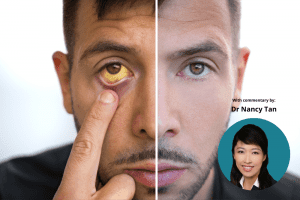 MCA Article Header Image Bilirubin
