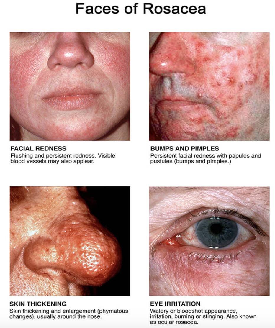 faces of rosacea symptoms