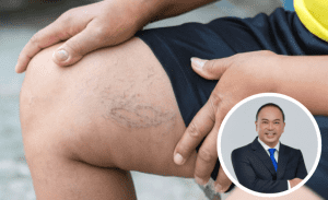 Varicose Veins Dr Tang Tjun Yip