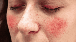 Woman with rosacea