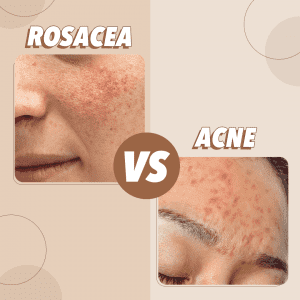 Acne vs Rosacea