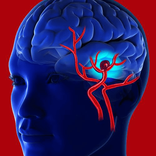 intracranial hematoma