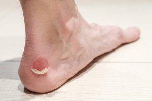 Foot Blister