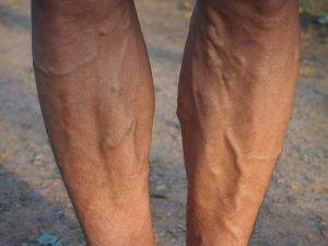 varicose veins