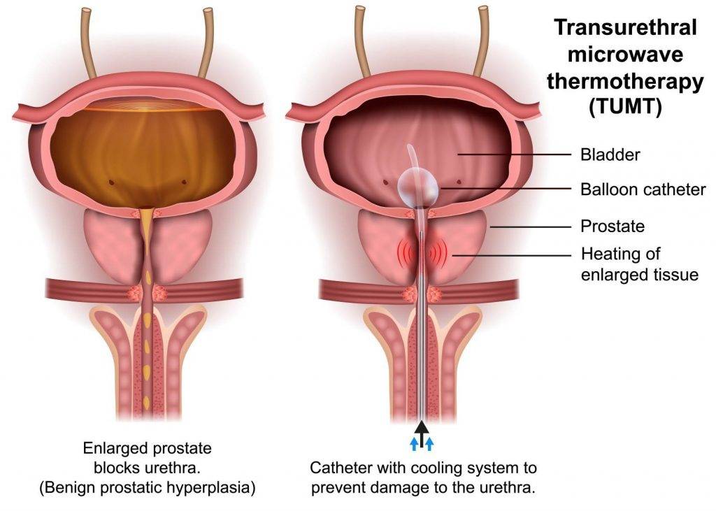 transurethral microwave therapy thermodilation