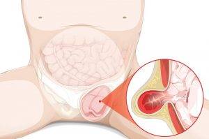 Inguinal Hernia 