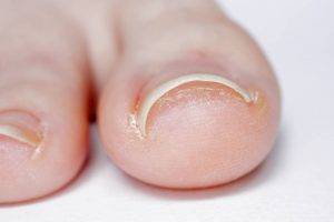 Ingrown Toenail