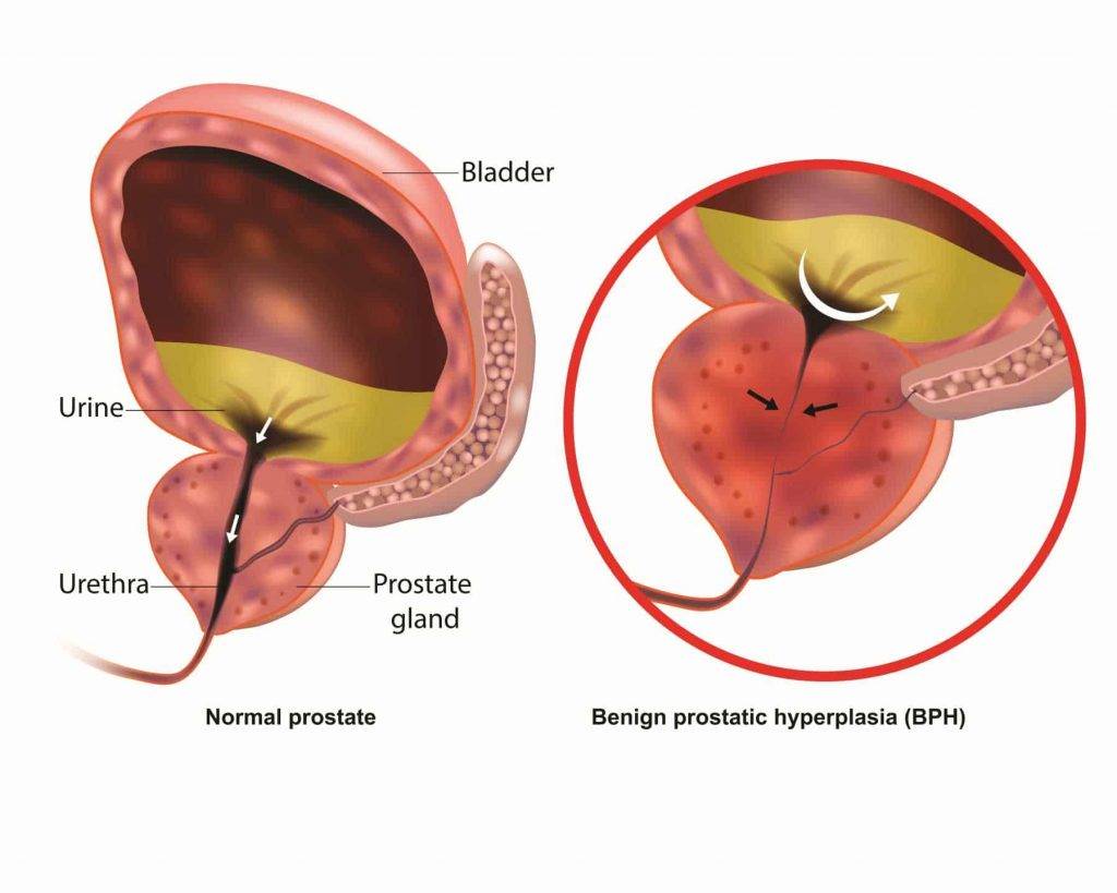 Image: Benign Prostatic Hyperplasia (BPH)