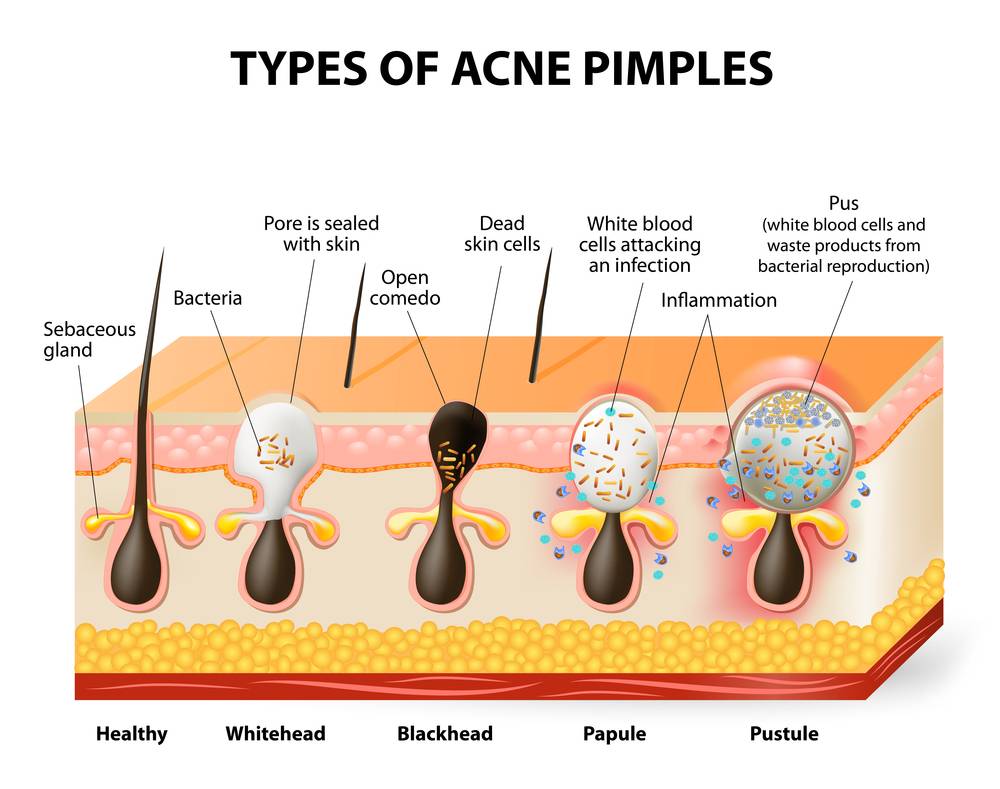 types of acne