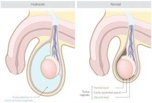  Hydrocele vs Normal Scrotum