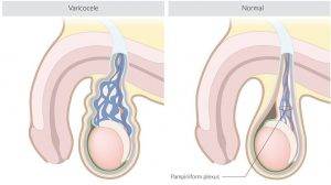 Varicocele vs Normal Scrotum