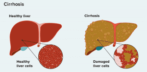 Figure 1 Liver cirrhosis