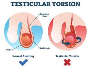 Testicular Torsion