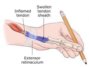 De Quervain's Tenosynovitis