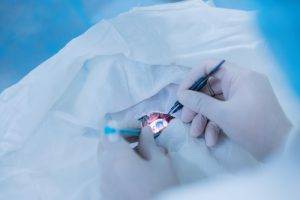 Lasik,Treatment,,Laser,Vision,Correction.,Doctor,Performs,Operation,Replacement,Of