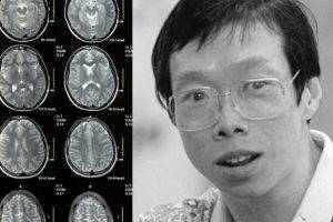progressive supranuclear palsy psp understanding the late dr lee wei lings condition