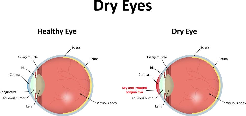 Dry,Eyes