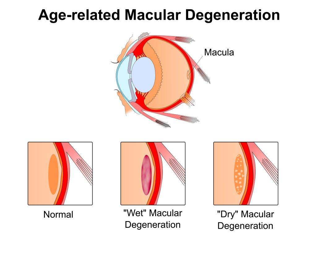 Age related,Macular,Degeneration.eye,Vision,Disorder.diagram,Of,The,Eye