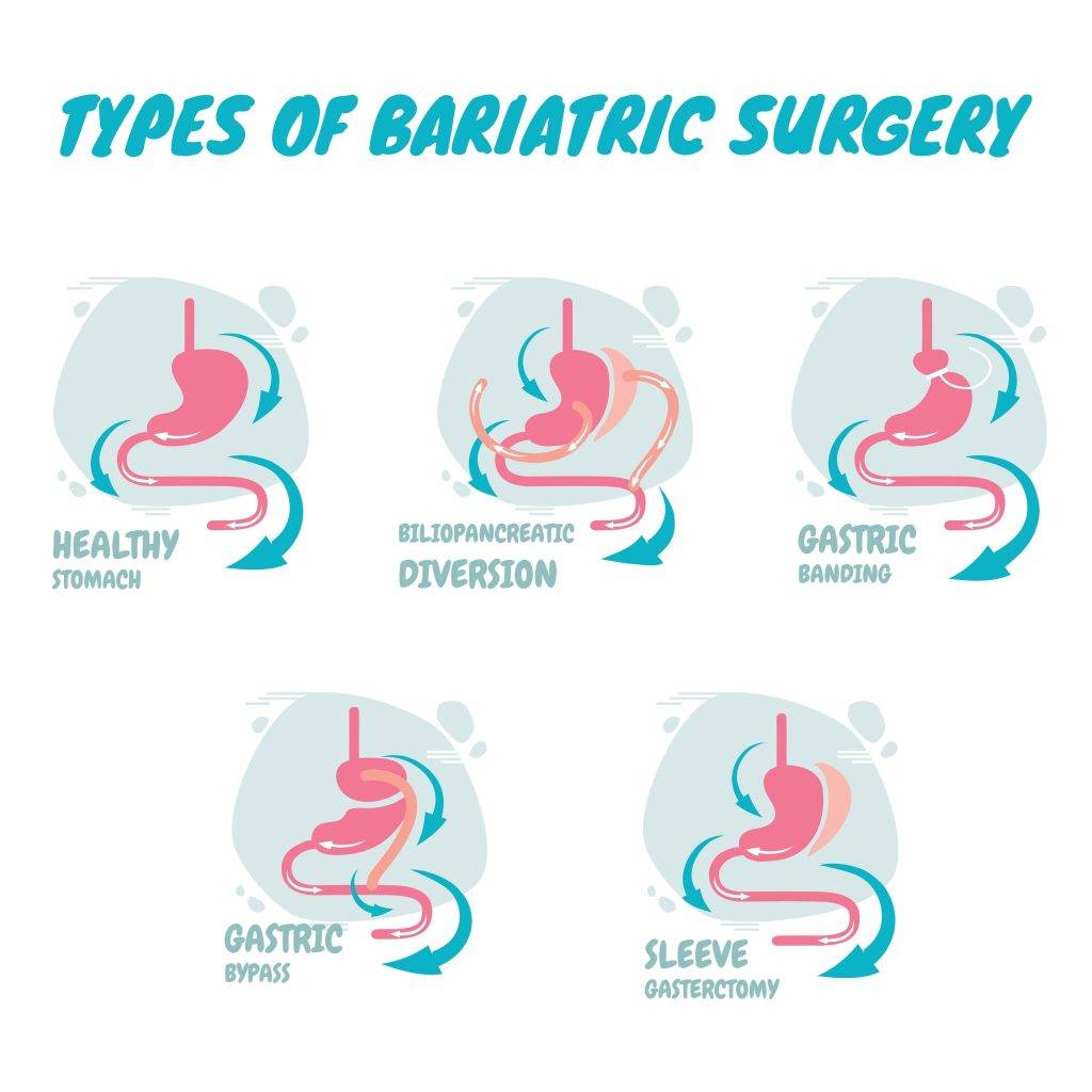 Types,Of,Bariatric,Surgery,,It,Is,Process,For,The,Digestive