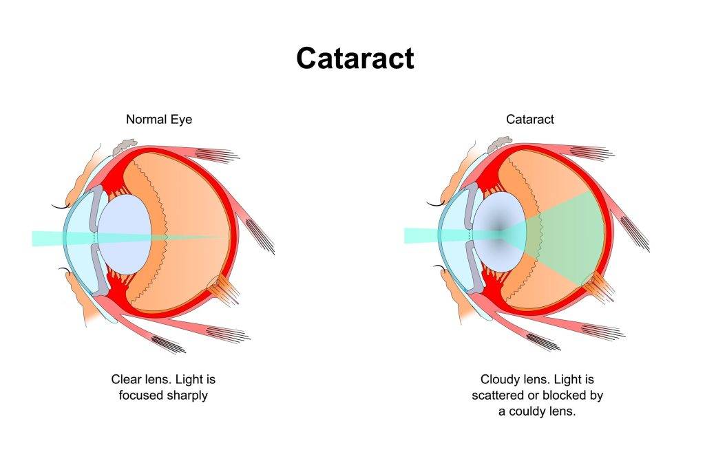 Cataract.,Eye,Vision,Disorder.diagram,Of,The,Eye