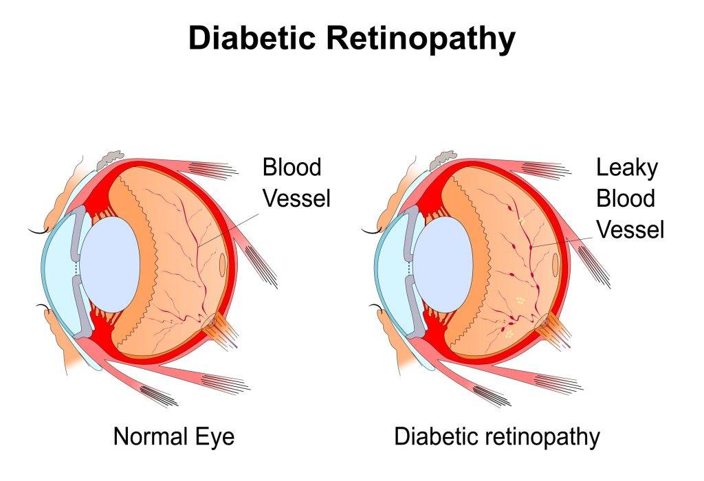 Diabetic,Retinopathy..eye,Vision,Disorder.diagram,Of,The,Eye