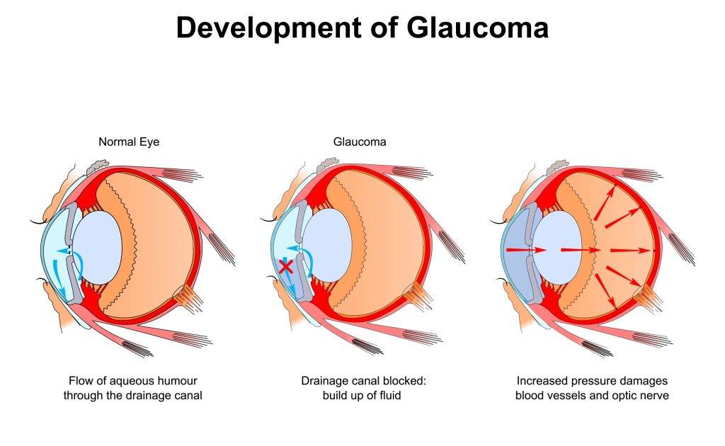 Development,Of,Glaucoma.,Diagram,Of,The,Eye