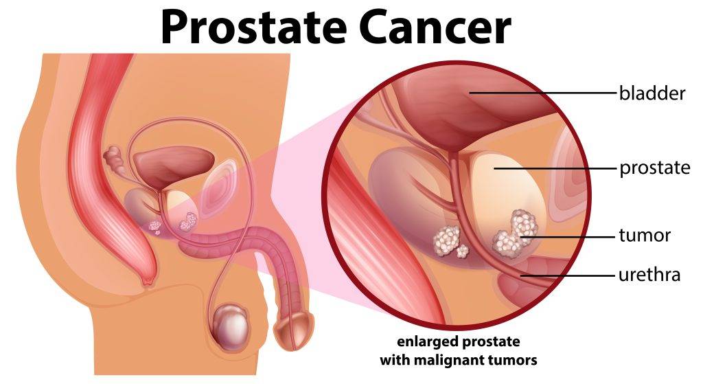 Diagram,Of,Prostate,Cancer,Illustration