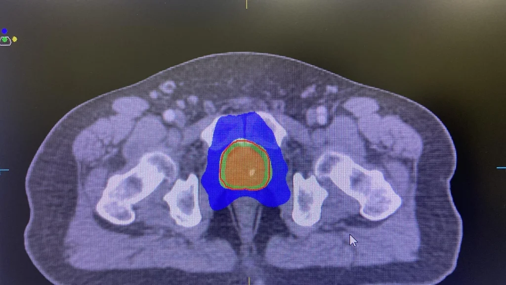 sbrt prostate