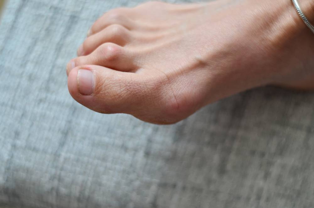 Closeup,Of,Barefeet,Woman,With,Medical,Condition,Called,Bunions,Or