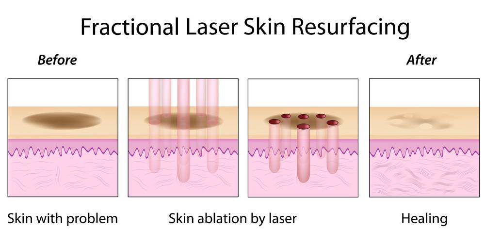 Fractional,Laser,Skin,Resurfacing