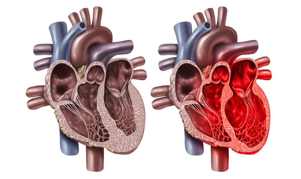 Broken,Heart,Syndrome,Or,Takotsubo,Cardiomyopathy,With,A,Healthy,Organ