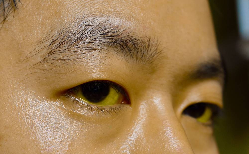 Yellowish,Discoloration,Of,Skin,And,Sclera,Or,Deep,Jaundice,In