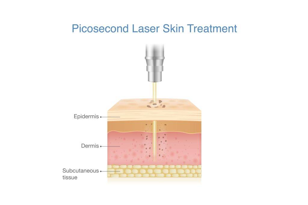 Reduce,Freckles,,Blemishes,,Wrinkles,And,Spots,By,Picosecond,Laser,Breaks